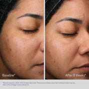 Before and after comparison of a person's face with visible skin improvement over 8 weeks.