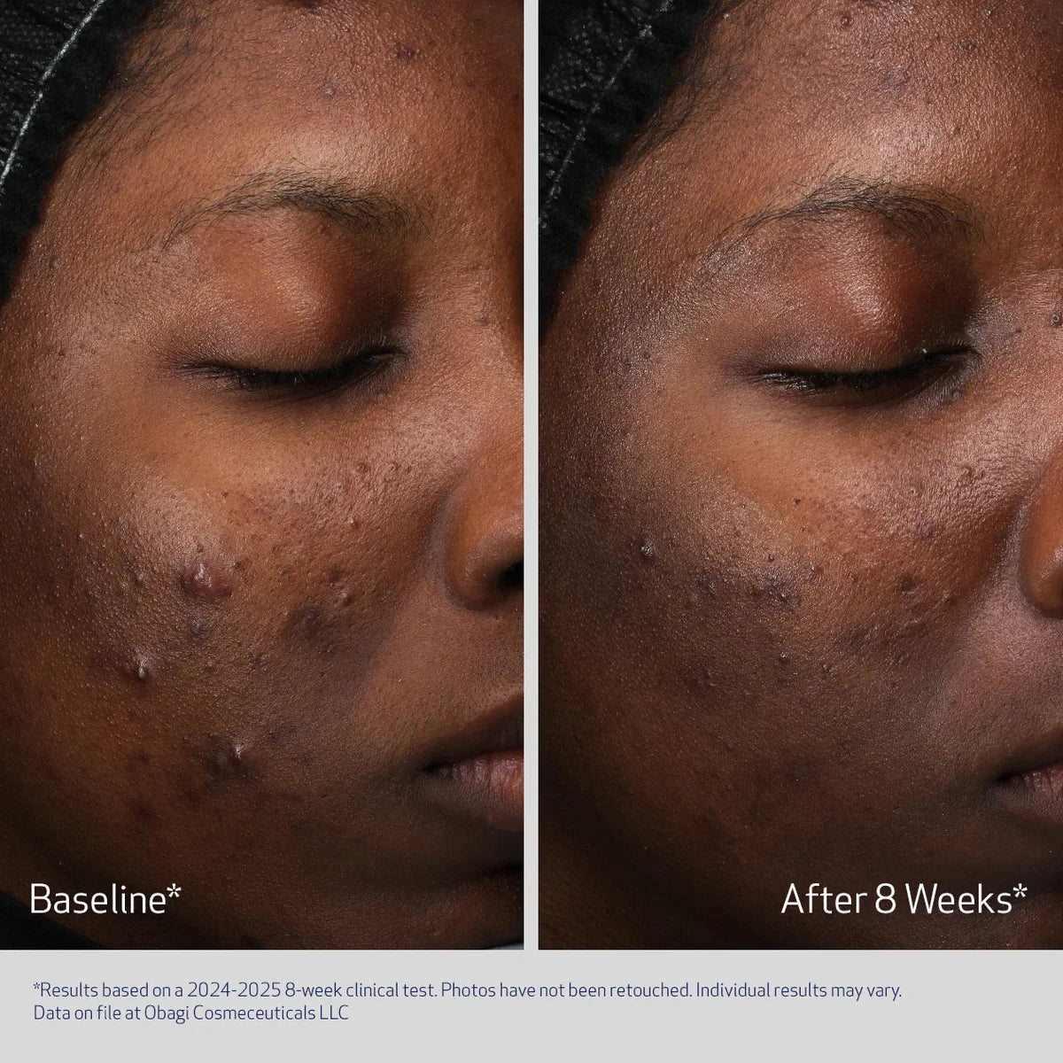 Before and after comparison of a person's face with visible skin conditions, showing improvement over 8 weeks.