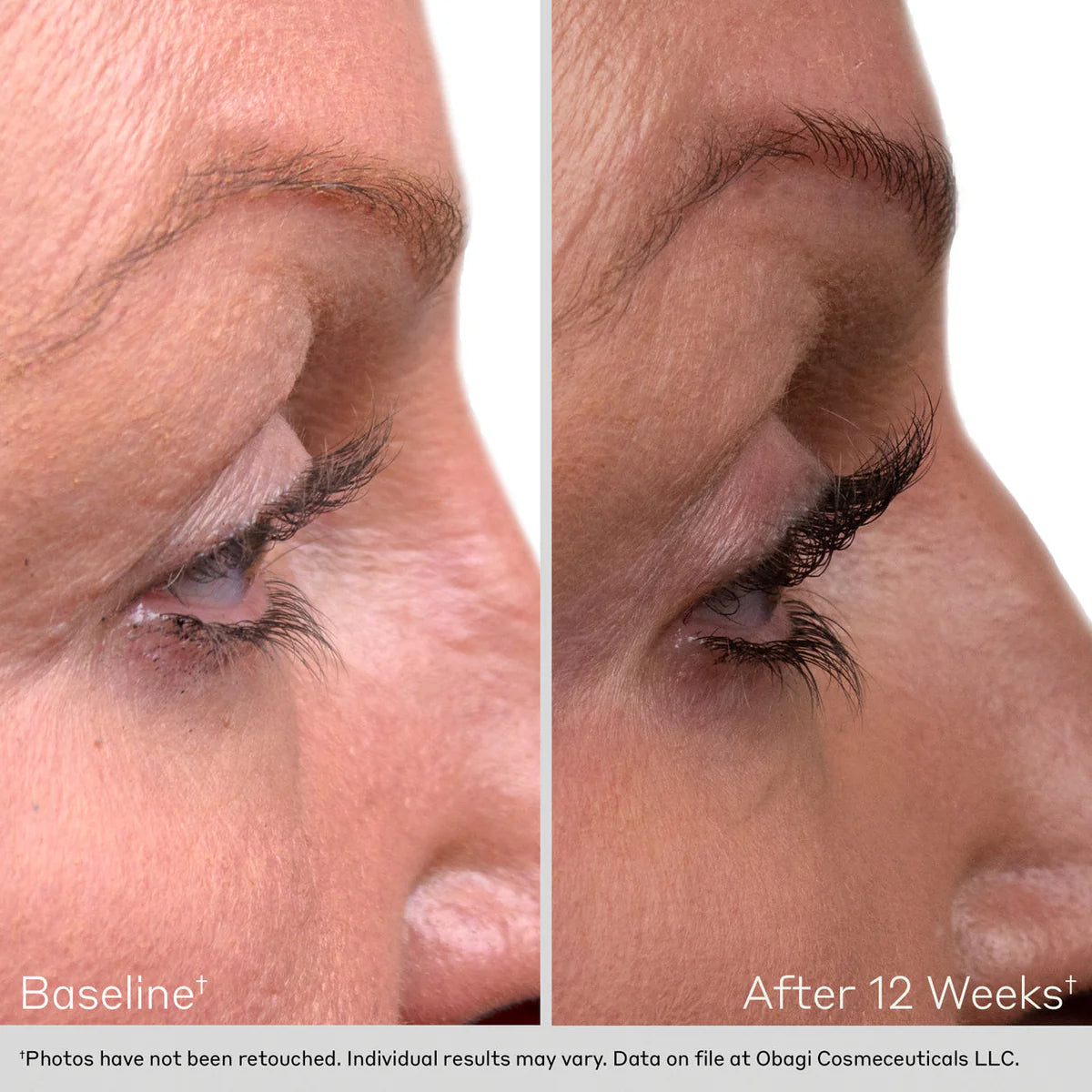 Before and after comparison of eye area treatment showing improved skin texture and eyelashes.