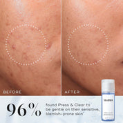 Before and after images of Medik8 Press & Clear exfoliating toner with 2% BHA.